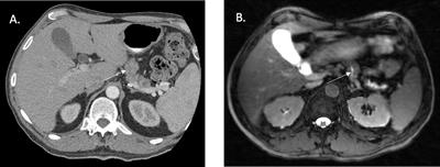 Magnetic Resonance Guided Radiation Therapy for Pancreatic Adenocarcinoma, Advantages, Challenges, Current Approaches, and Future Directions